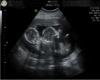 !O! Twins Ultrasound Pic