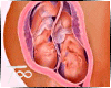 T Pregnancy twins