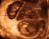 butterycups ultrasound