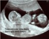 twins scan