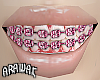 ak. pink braces F