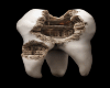 Caries Tooth ( M )