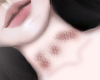 bruises neck