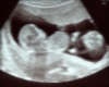 Twins Ultrasound