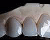 M^ Diamond Cut Veneers F