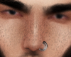freckles