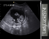 Baby Boy ultrasound 