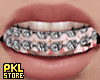 Braces