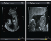 sonograms of twins