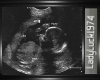 6 months Ultrasound