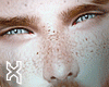 Freckles