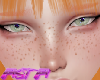 A. Freckles
