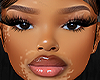Nocy Vitiligo T3 Skin