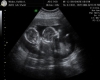 {TK}TWINS ULTRASOUND PIC