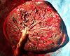 After Birth Cut Placenta