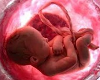 ( IGD ) utero com bebe