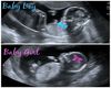 B/G Twins Ultrasound