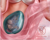 Δ Genesis Gem Baby DERV