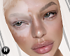 H | Vitiligo Mel MH