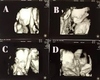 Quadruplets Ultrasound