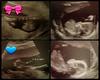 Twins Ultrasound