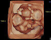 Twins Ultrasound Picture
