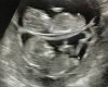 twins ultrasound pic
