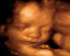 Ultrasound Picture