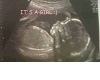 Baby Girl Ultrasound