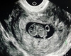 8 Week Ultrasound Pic
