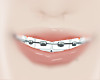 Braces |Teeth|