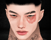 埃尔. eye bruise