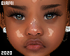 Serena MH -T3 Vitiligo